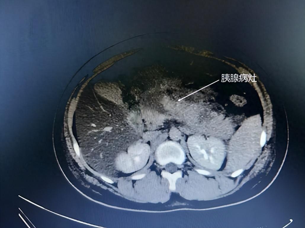 广东云浮一名14岁男孩小杰，午饭一口气狂炫6个鸡腿、几大块红烧肉，没多久