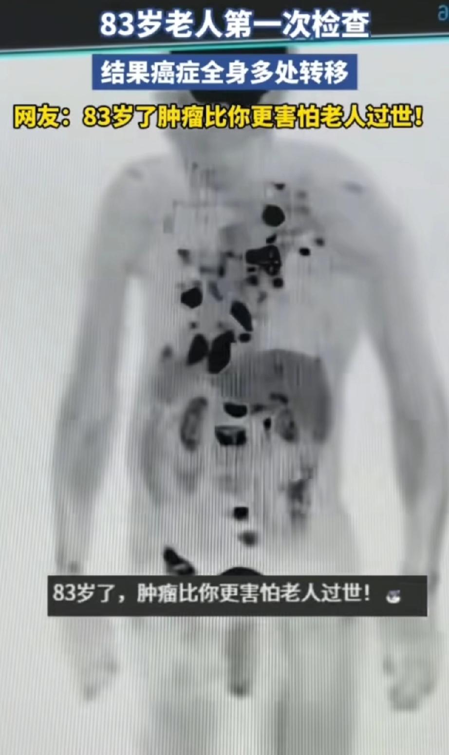 岁数大的好处！安徽，83岁老人首次做全身检查，没成想片子上显示，老人身上的癌症已