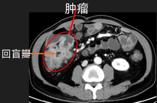 “以为就是吃坏肚子”上海一男子接到瑞金医院“连环call”! 真的没想到……