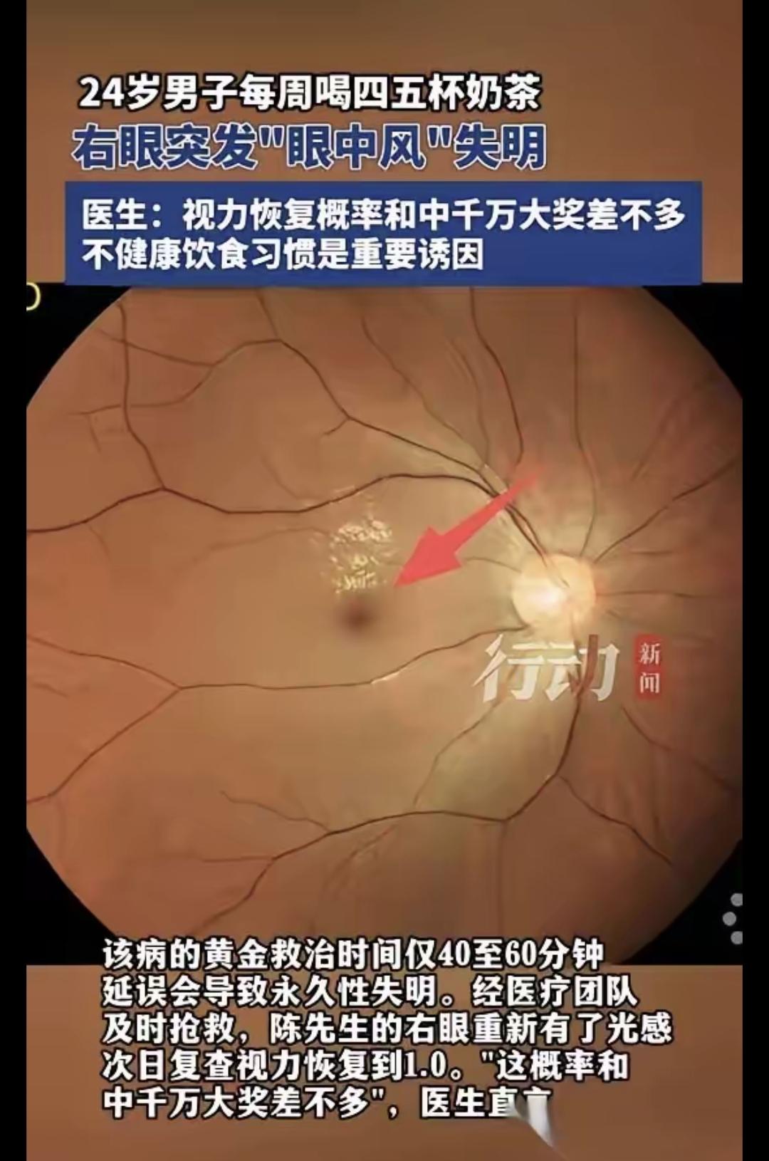 那天晚上十一点多，小陈右眼一下子就黑了，不是手机屏碎，是真看不见。他才24岁，体