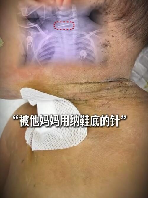 云南墨江最近有个事儿挺让人揪心的。一个才十个月大的男婴，因为发烧抽搐被送到医院，