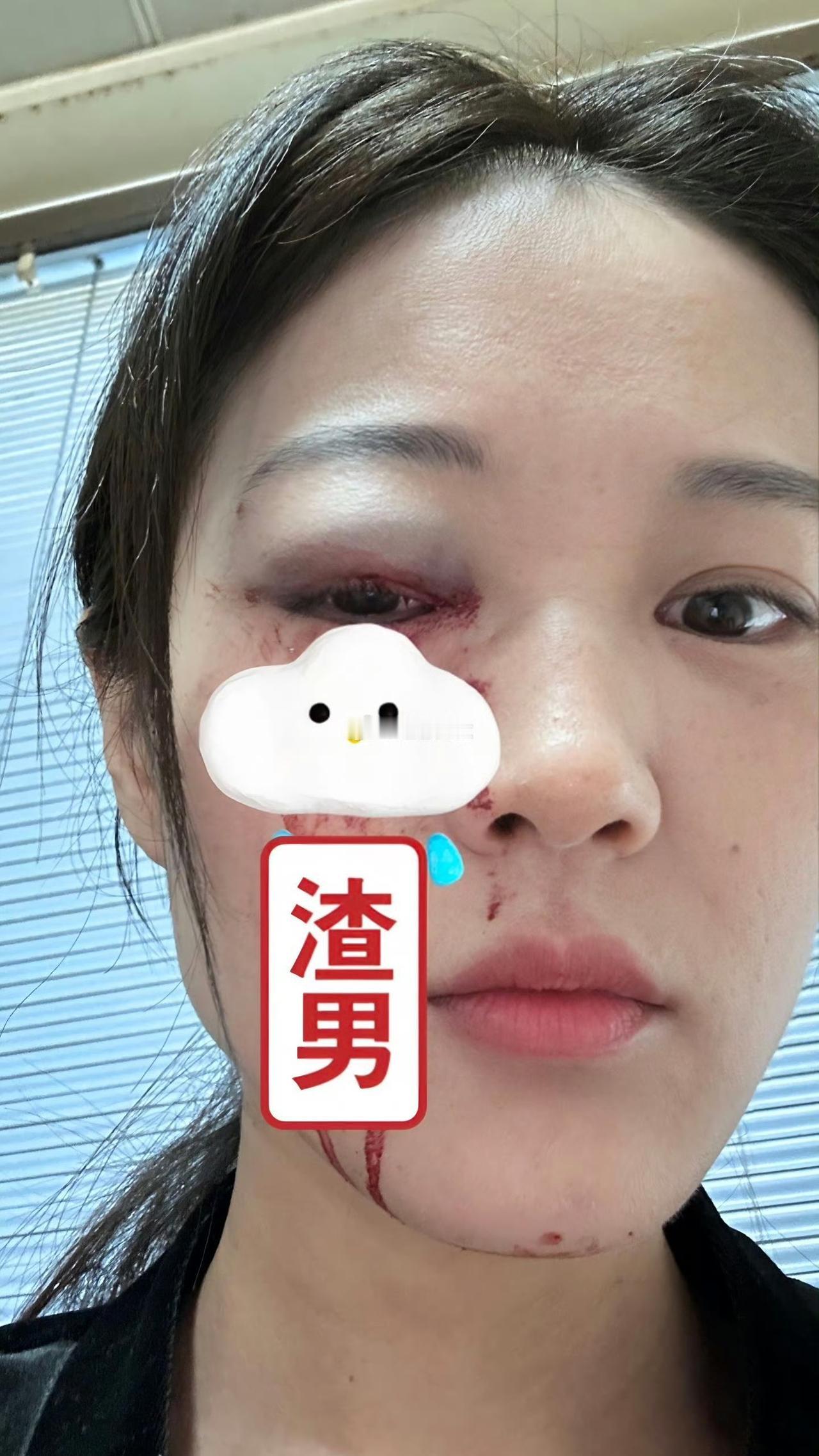 一山东济宁网友爆料，遭遇家暴出轨渣男，网友报警，也立案了。看眼睛，被打的不轻啊，