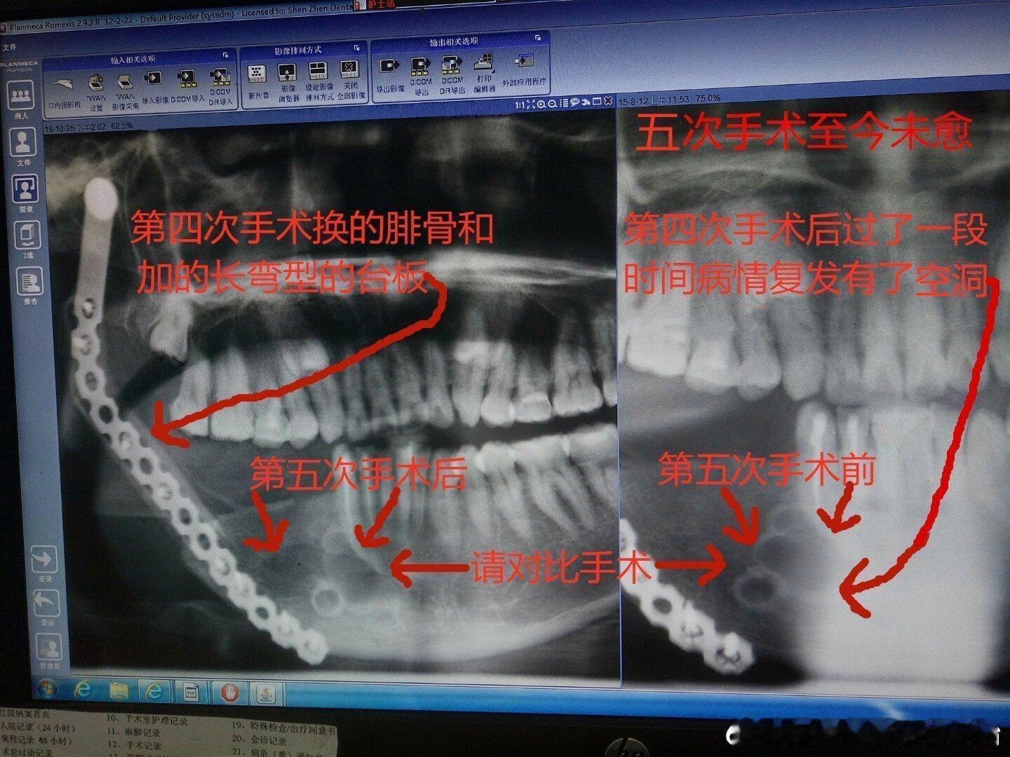#脑瘫女儿活到18岁爸爸守了9年#广东省深圳市北京大学深圳医院做的5次手术，第1次至第3次手术做根管