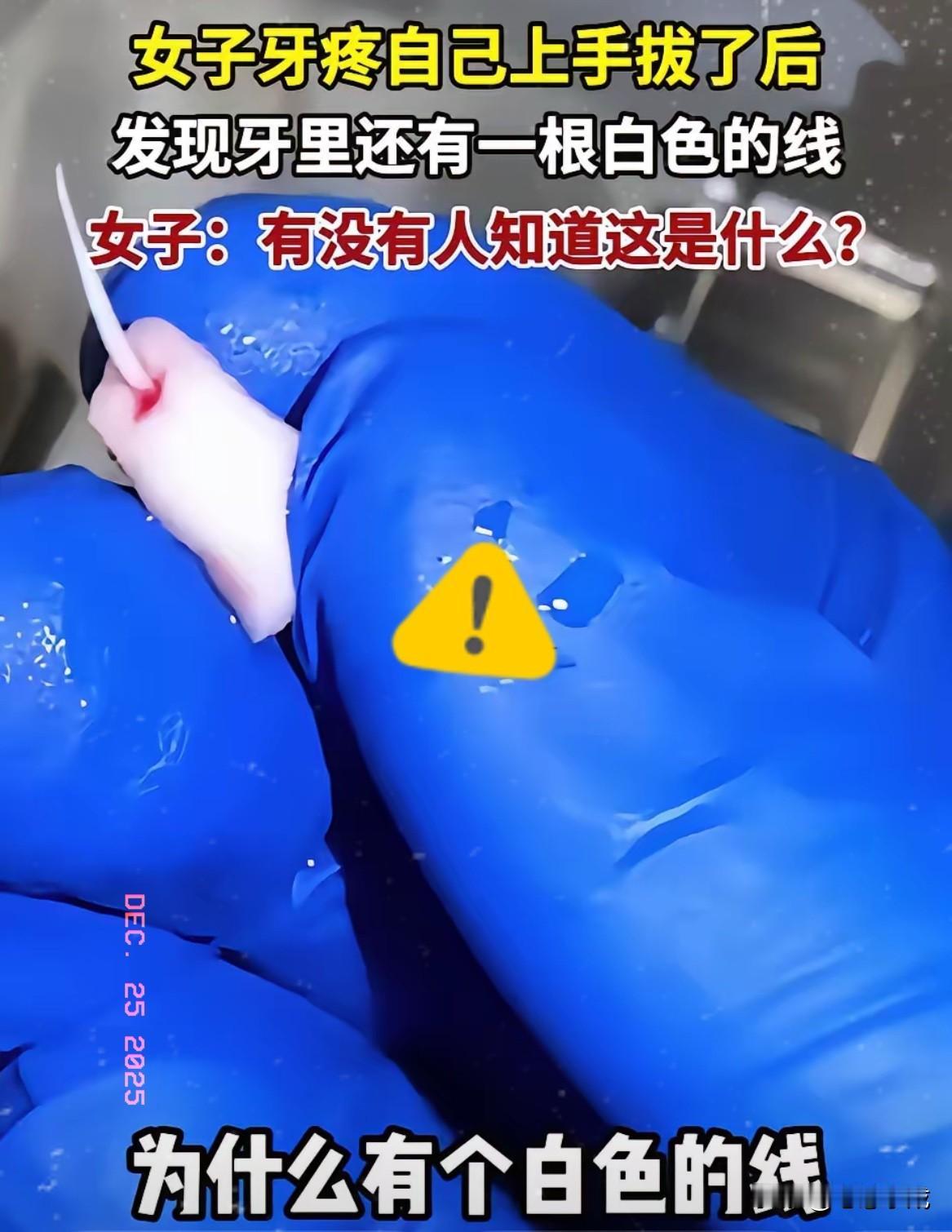自己拔牙还拔出“白线”？别慌！这可不是什么奇怪东西，但硬来的后果真的怕了！其