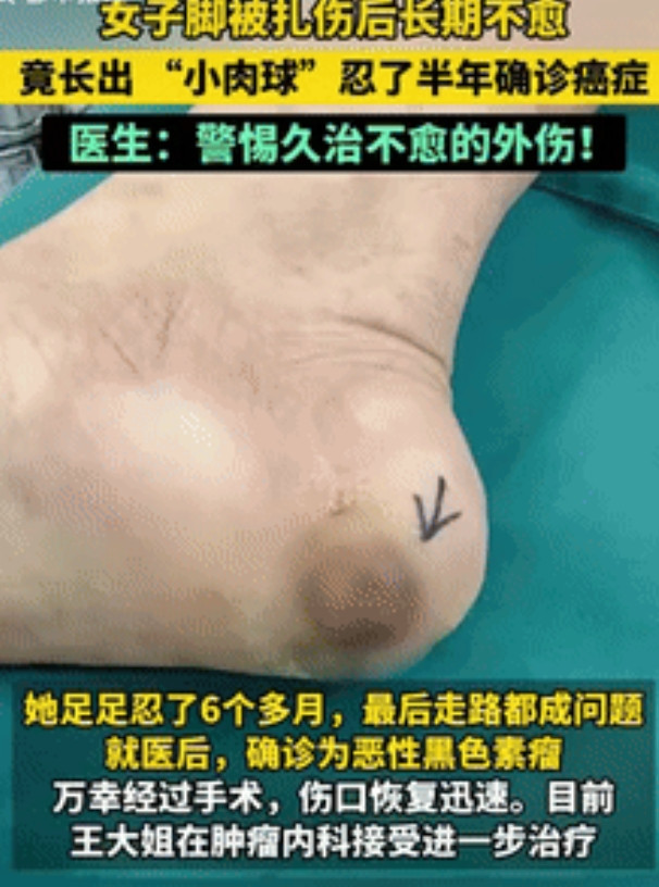 “悲剧还是发生了！”浙江杭州，一50多岁女子的脚被扎后，只是简单的处理了下伤口，