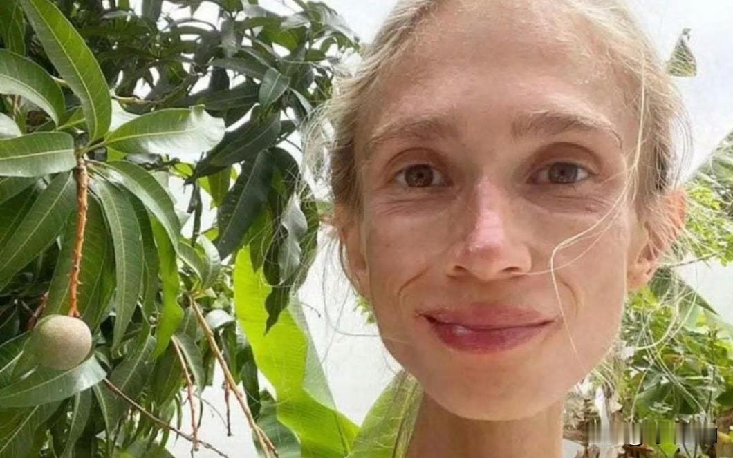 波兰27岁女子是素食主义者，她因长期以水果为食，导致营养不良，还讳疾忌医，最终在