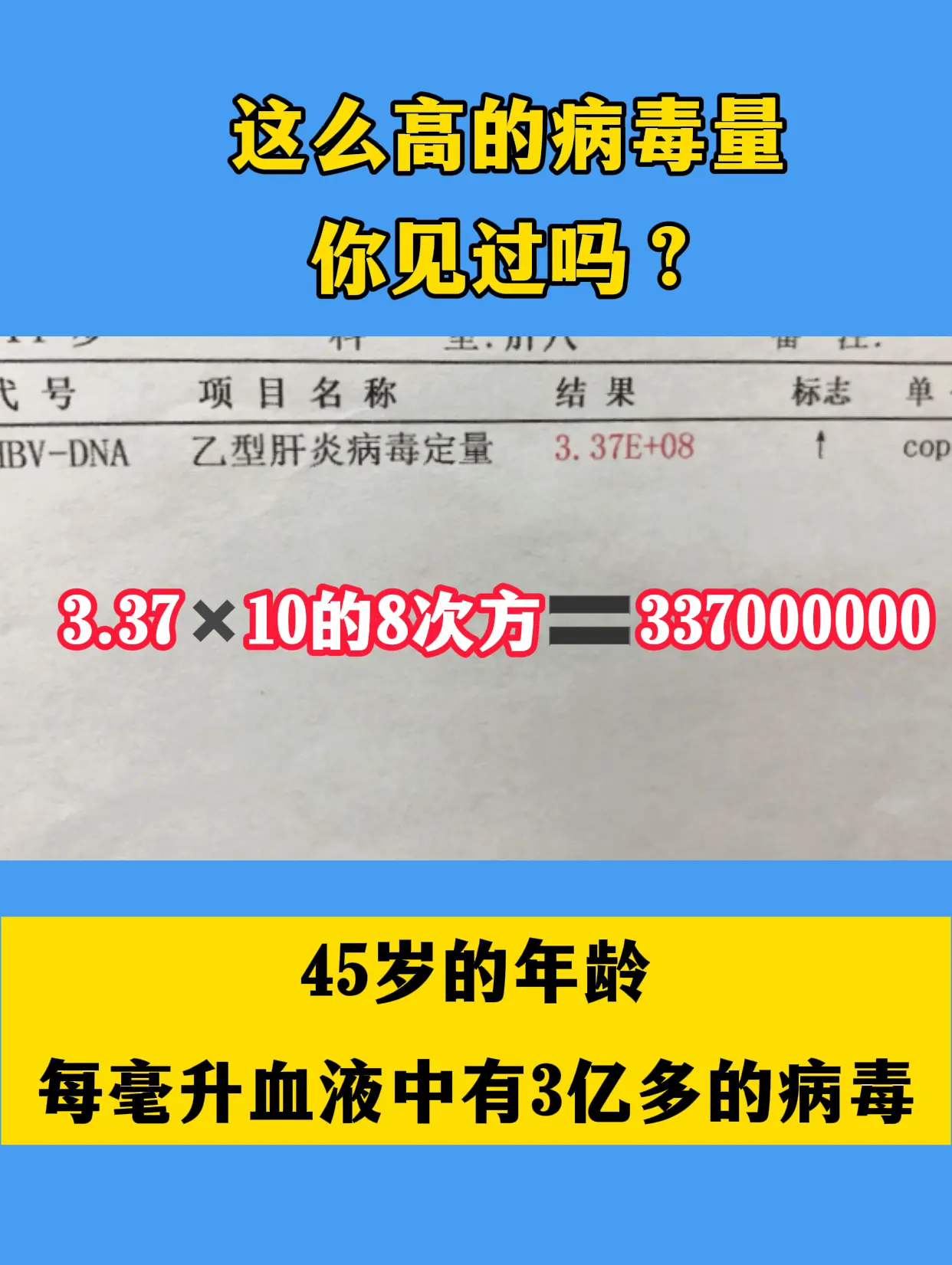 这位来自济南本地的患者刚查出乙肝，病毒量8次方，每毫升血液中有3亿多的...