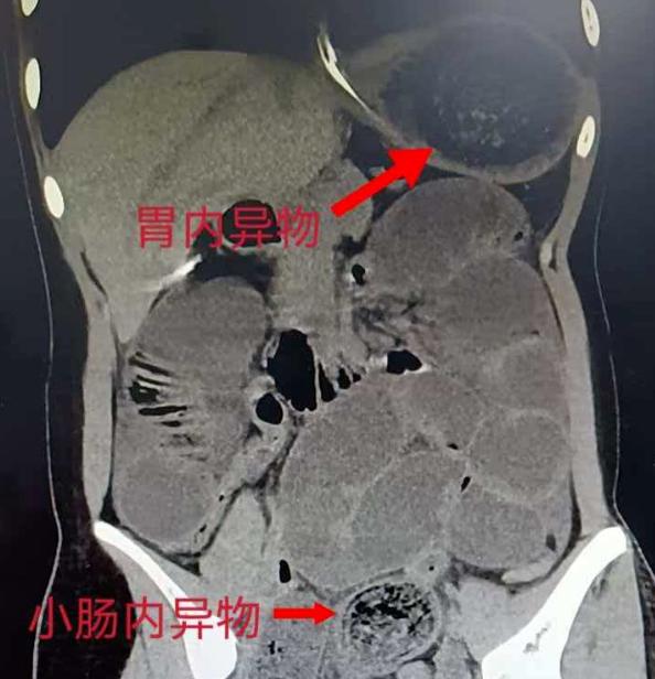 广东佛山，13岁女孩连续8天腹痛、频繁呕吐，身体急剧下滑。送医后CT结果让所有医