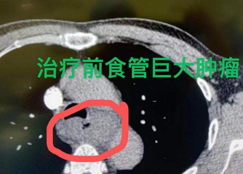 63岁老教师的抗癌记：8cm大肿瘤竟几乎消失！前段时间接诊了一位老教师，印象特别