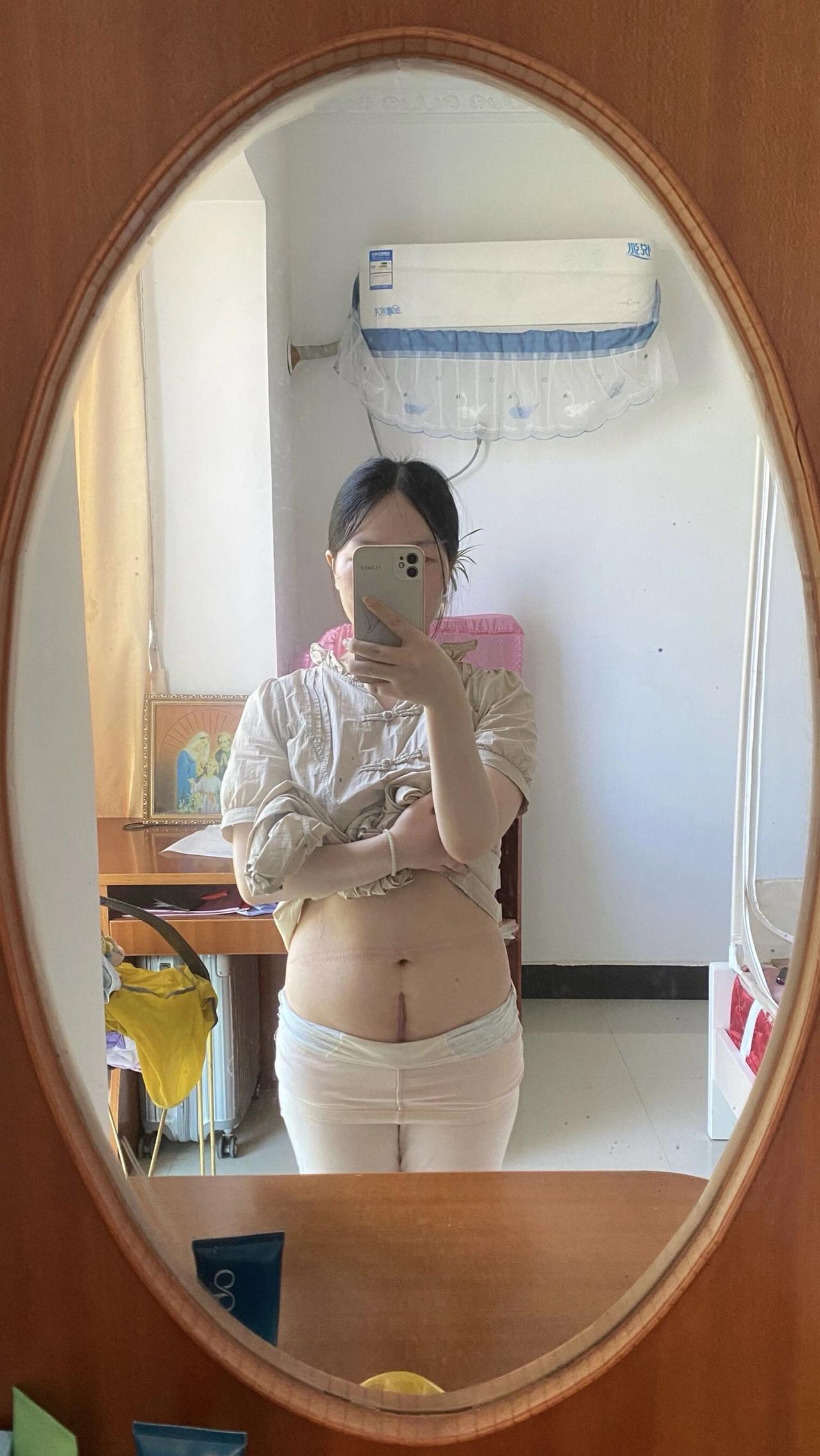 这道疤痕，是成为妈妈独有的勋章跟着疾风摇起来美图分享