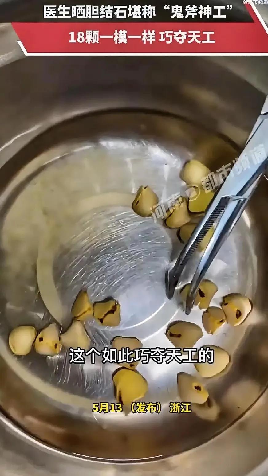 近日，在浙江，一医生竟然晒出了18颗一模一样的胆结石。该医生面对媒体记者还说，真