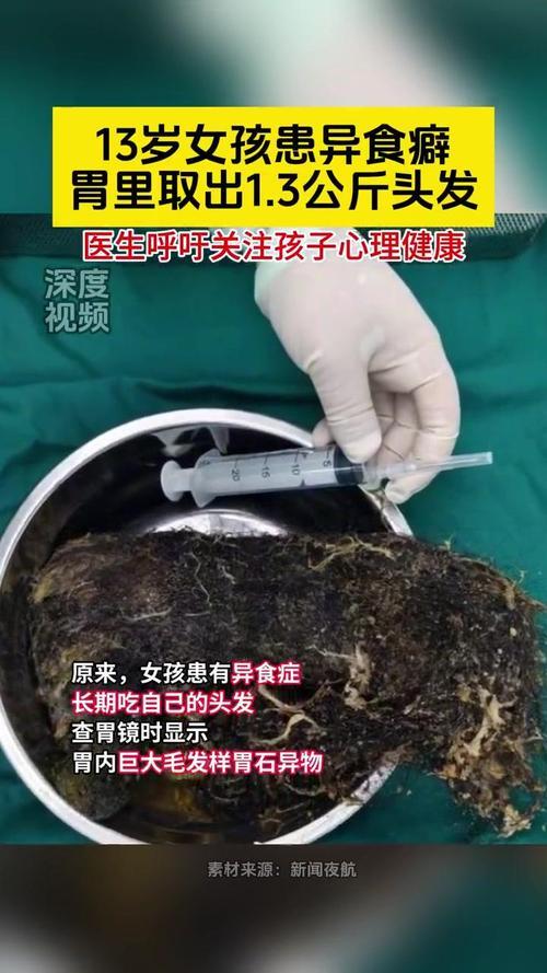 杭州这事儿太吓人了！25岁的佳佳腹胀三四个月，肚子硬得像石头，去医院一查，胃里竟
