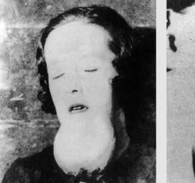 1922年，有一名25岁的少女因为牙疼去看病当医生轻轻的触碰牙齿时，她的下颚骨却