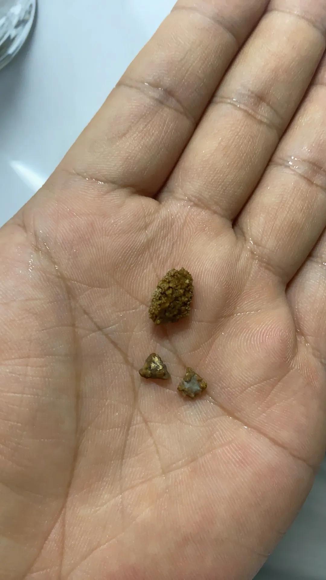 前几天半夜，我老伴突然大汗淋漓腹痛不止，伴随着上吐下泻，难受死了。我们只好打车去