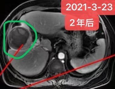 肝癌有时候退缩非常缓慢。患者女性，75岁，乙肝病史，DNA病毒控制正常...