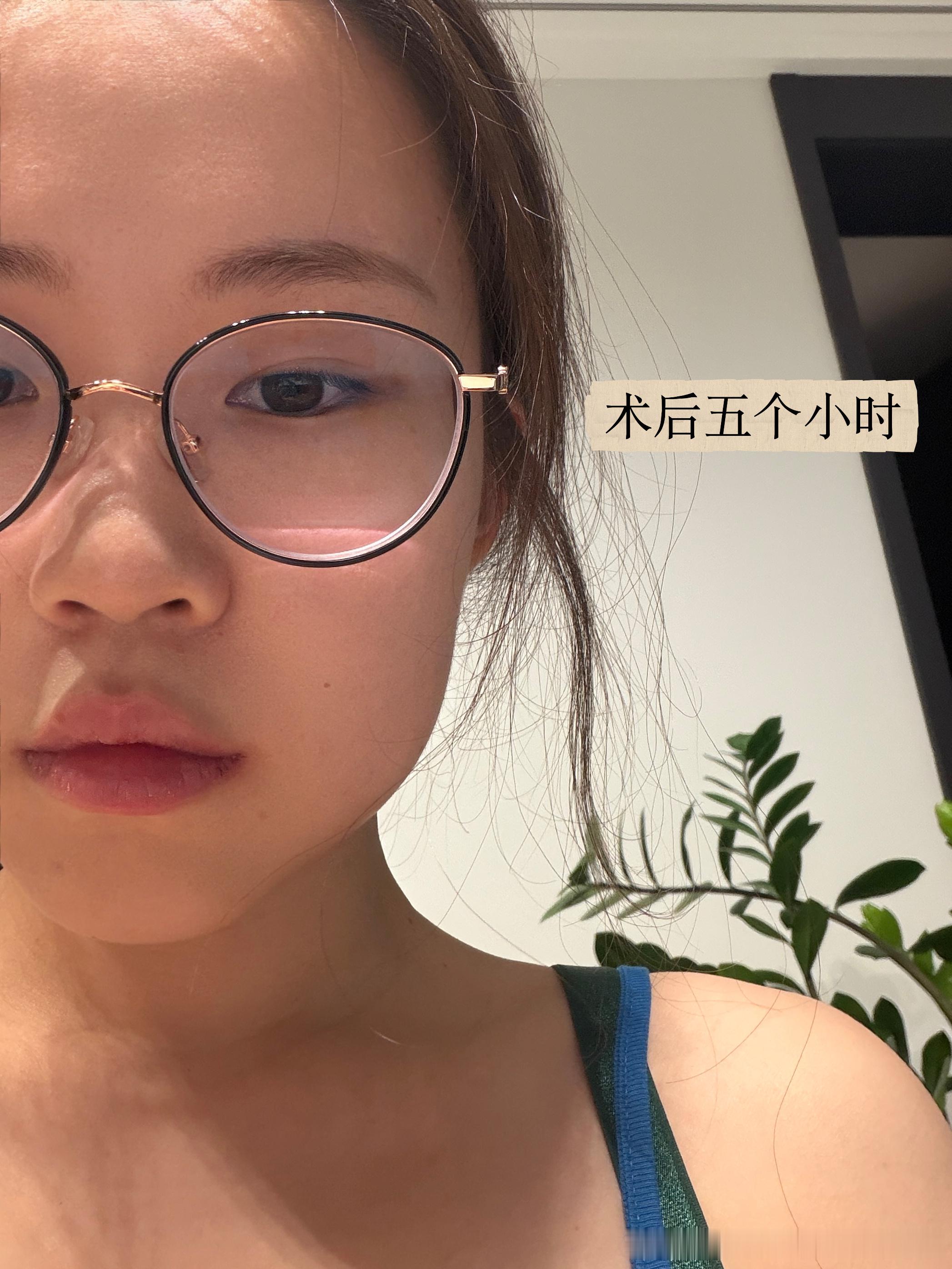 拔智齿初体验，墨迹了四个月终于拔了，跑了三次医院才下定决心，最后还是学生陪我拔的（还给我贴心地买了我