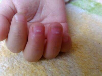 婴幼儿指甲白点及修剪注意