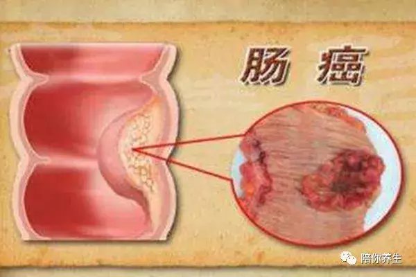 过点“苦日子”能够有效地预防肠癌 你一要试试