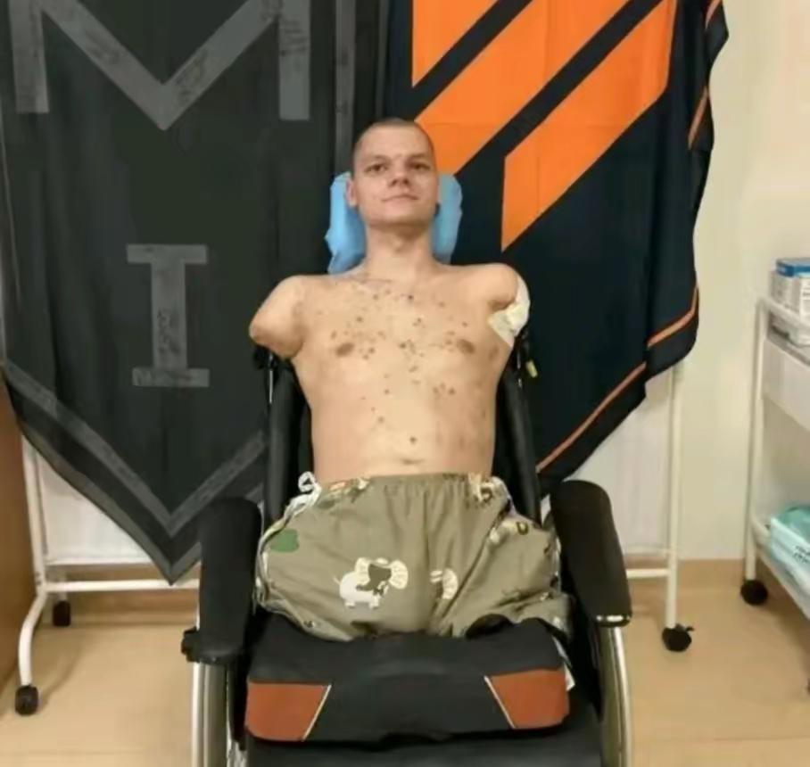 乌克兰战争的牺牲品，也是一个所谓的“国家英雄”！这样的英雄有何意义？双手双腿都