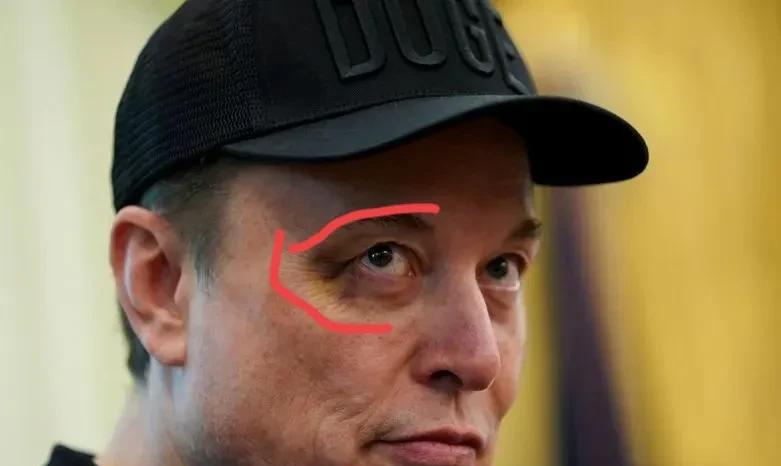 世界第一首富马斯克眼睛淤青被热议，世界第一首富就要告别白宫的工作，就在这特殊时刻