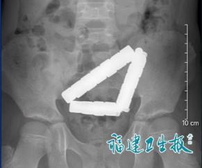 太吓人了！福州，一10岁娃，半夜突然肚子疼得满地打滚，吓得爸妈赶紧送医。可谁都没