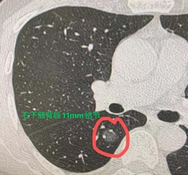 说实话，在临床中碰到肺结节患者，大概三分之一的人查出的都是多发结节，而且其中大部