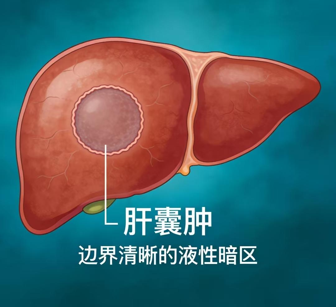 常常听别人说囊肿打一针就可以消除还不太相信，今天亲眼见证了一位肝囊肿患者10几分