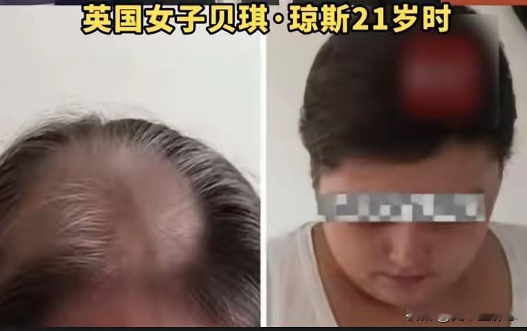 一女子21岁时，被确诊脑癌晚期。她坚持化疗11年后，竟得知自己压根没患癌。女子崩
