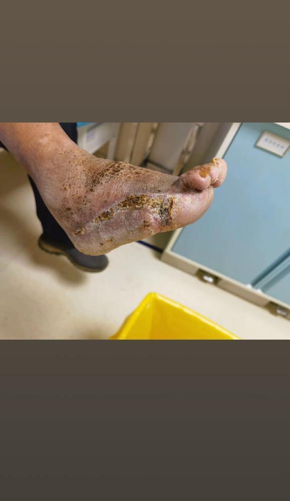同志们一定要控制血糖！我家表叔得二型糖尿病五年了，平时啥症状没有就胡吃海塞