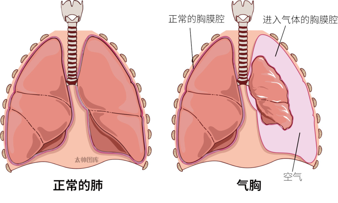 方大同什么病早在十几年前就传他有“气胸”。简单说就是肺“漏气”，破了口子。港台