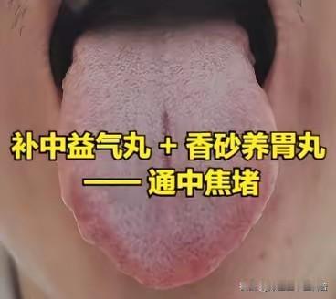 补中益气丸+香砂养胃丸：巧解气虚湿滞，补通兼顾调脾胃大家好，我是陈大夫！