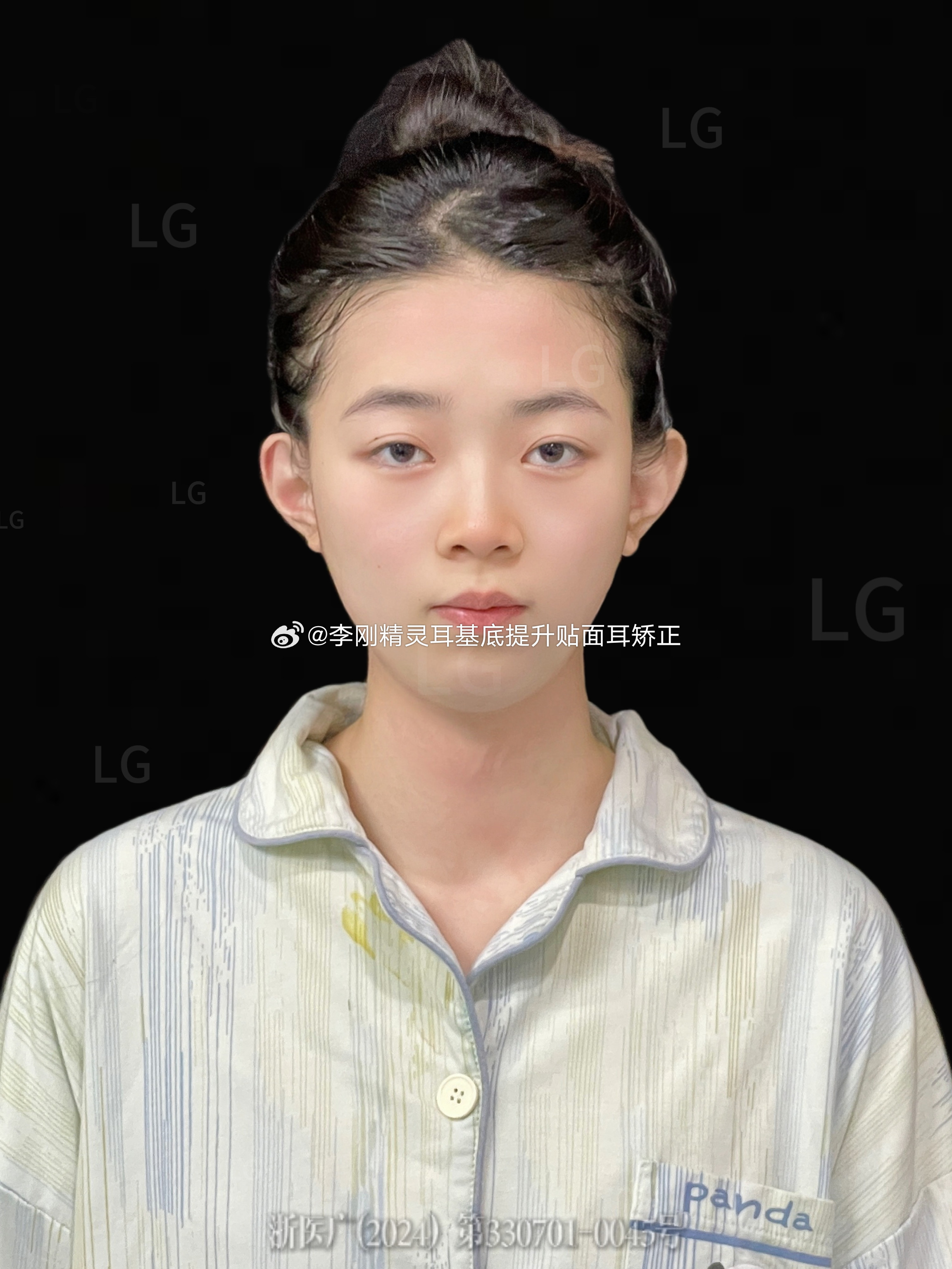 告别贴面耳啦李刚精灵耳南京精灵耳耳基底提升膨体精灵耳正面看不到耳朵