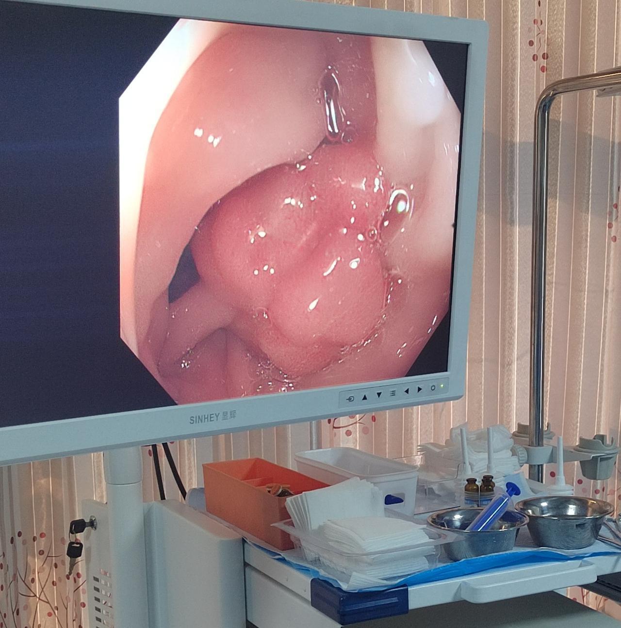 “今天这个肠镜是做着了，也是没有做着，太让人难受了！”一位62岁的大叔麻药劲过了