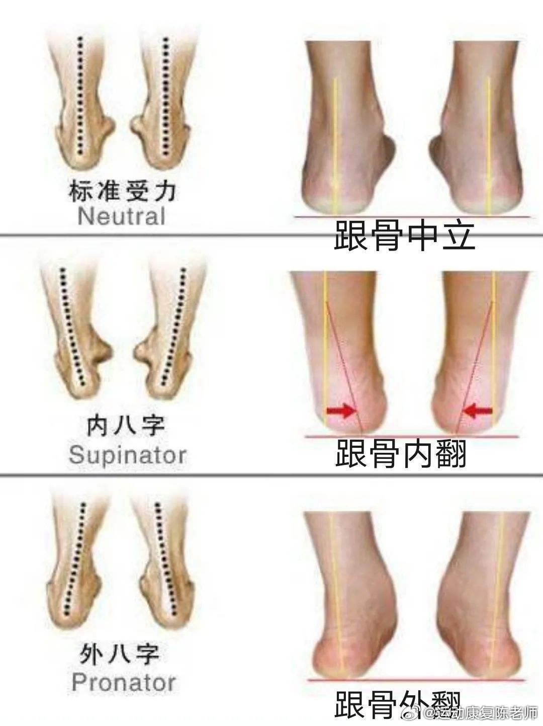 你有脚后跟吗今天聊一个大家都知道，但平常不会想起来的部位——你的脚后跟，也就是