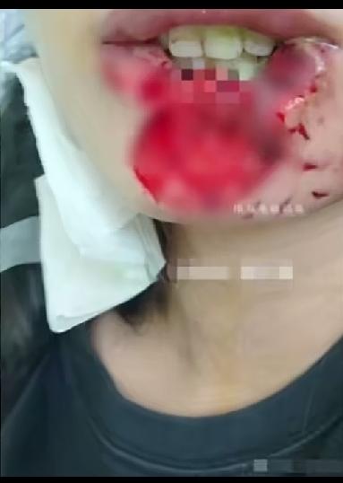 女子喝多了，躺床上睡，被自家狗狗吃掉了下嘴唇下巴，等她醒了，也没有感觉到痛，只是