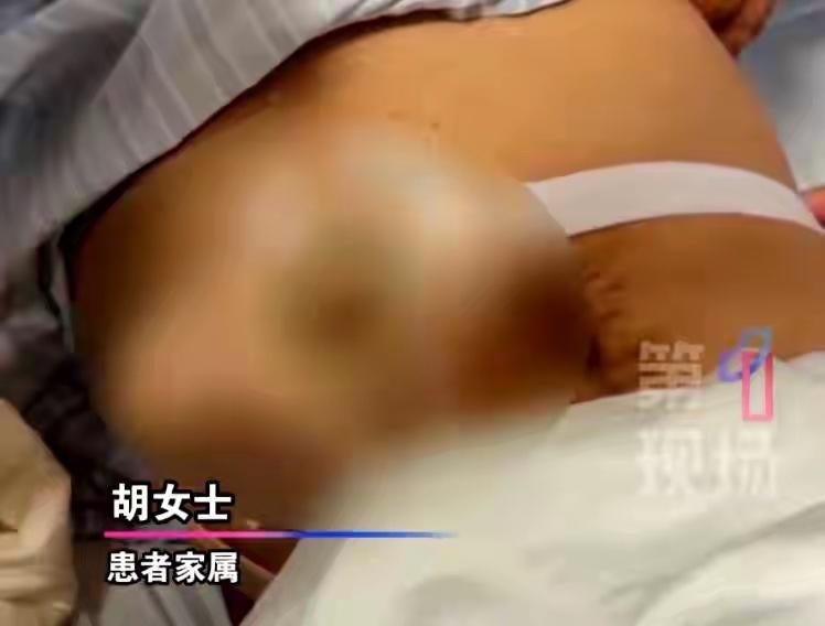 好家伙，深圳大叔便秘十多天结果从嘴里喷粪！敢情是乙状结肠里肿瘤把肠子堵成了死胡