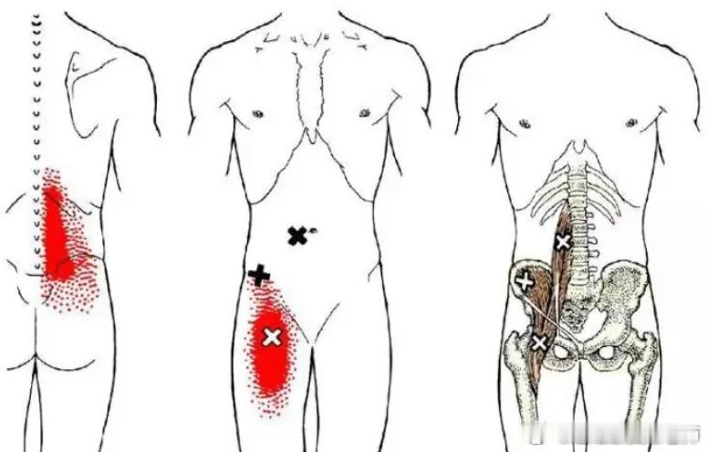 腰背部筋膜炎和腰肌劳损的区别腰背部筋膜炎和腰肌劳损，其实是不同的两种损伤，今天