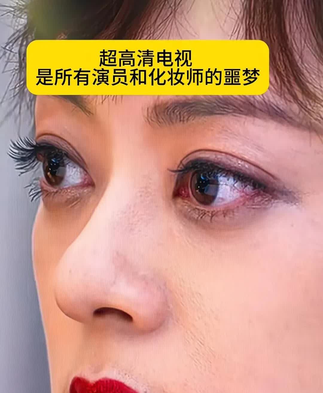 孙俪这颗痣不除不行呀，粉底都盖不住，简直是化妆师的噩梦，对比拍甄嬛传时，这颗痣不