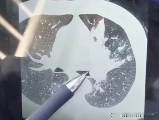 以为是炎症，实际却是肺癌！门诊一位61岁的男性患者，去年做了CT，当地医生说考虑