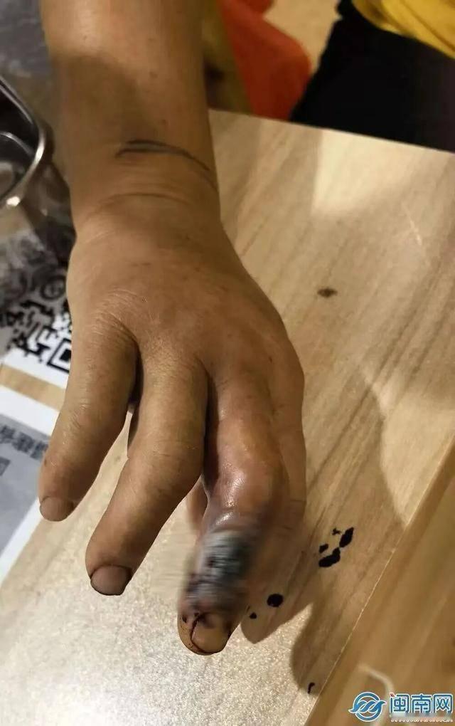 被毒蛇咬了怎么办？大多数人的第一反应是跑、是叫、是慌。可福建泉州这位53岁的