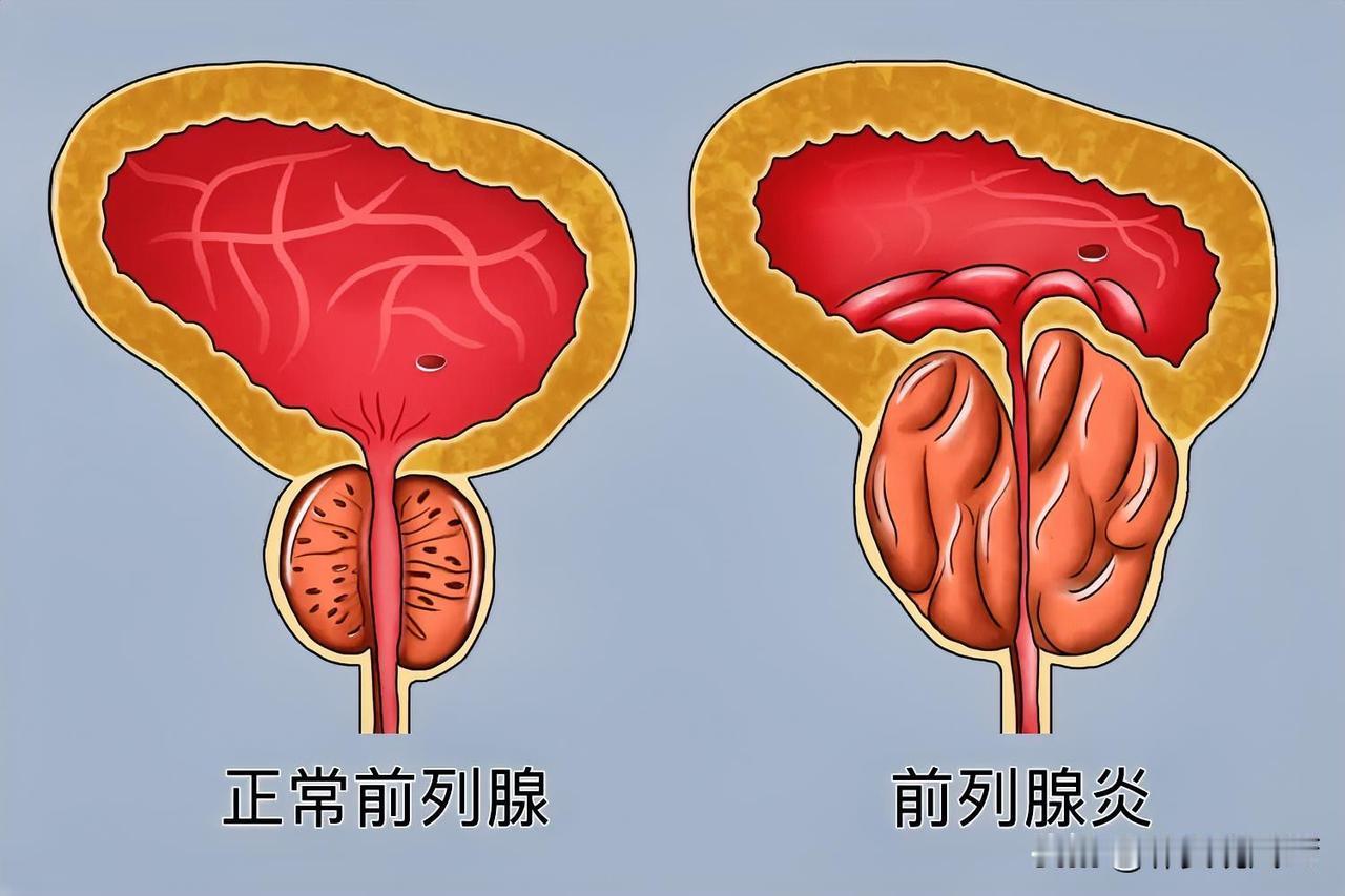 前列腺炎“缠上身”怎么解决?前列腺炎可是男人特有的毛病，年轻朋友要想不被它缠