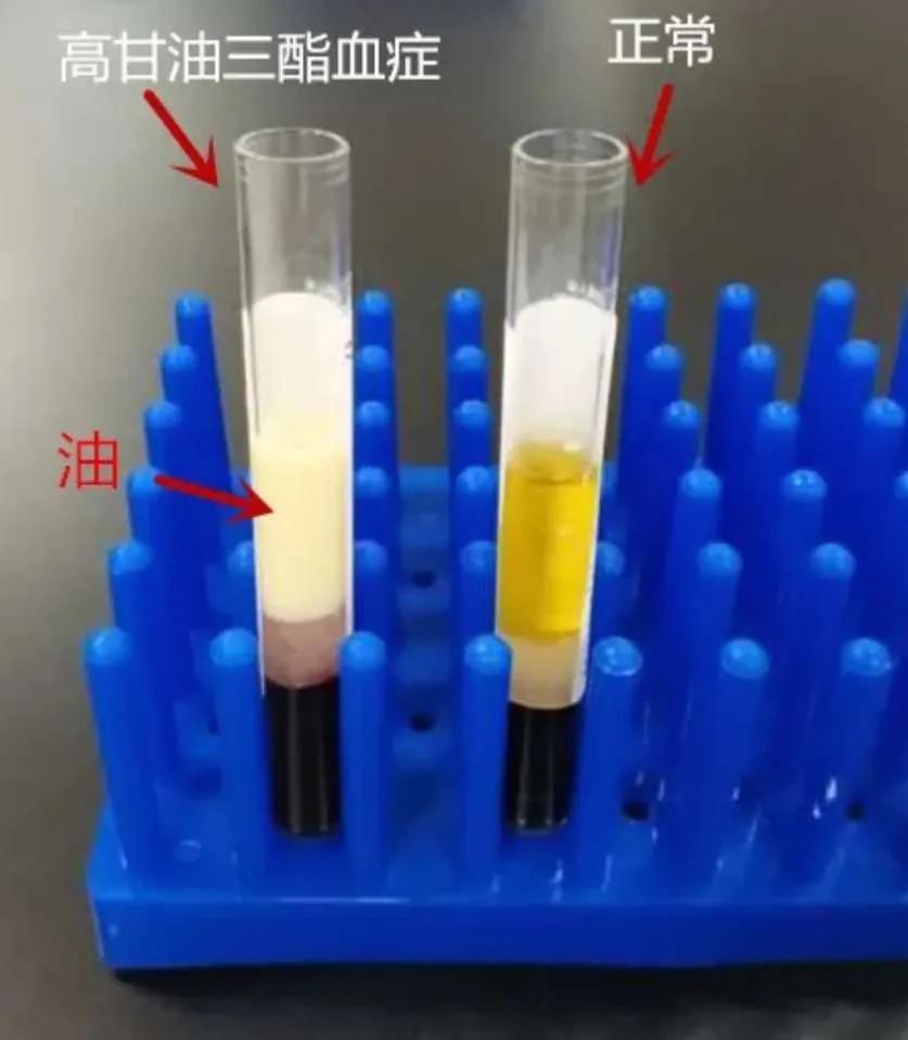 血脂偏高该咋办？只吃素没用，多数人调理全错了很多人觉得血脂偏高，只要天天吃素