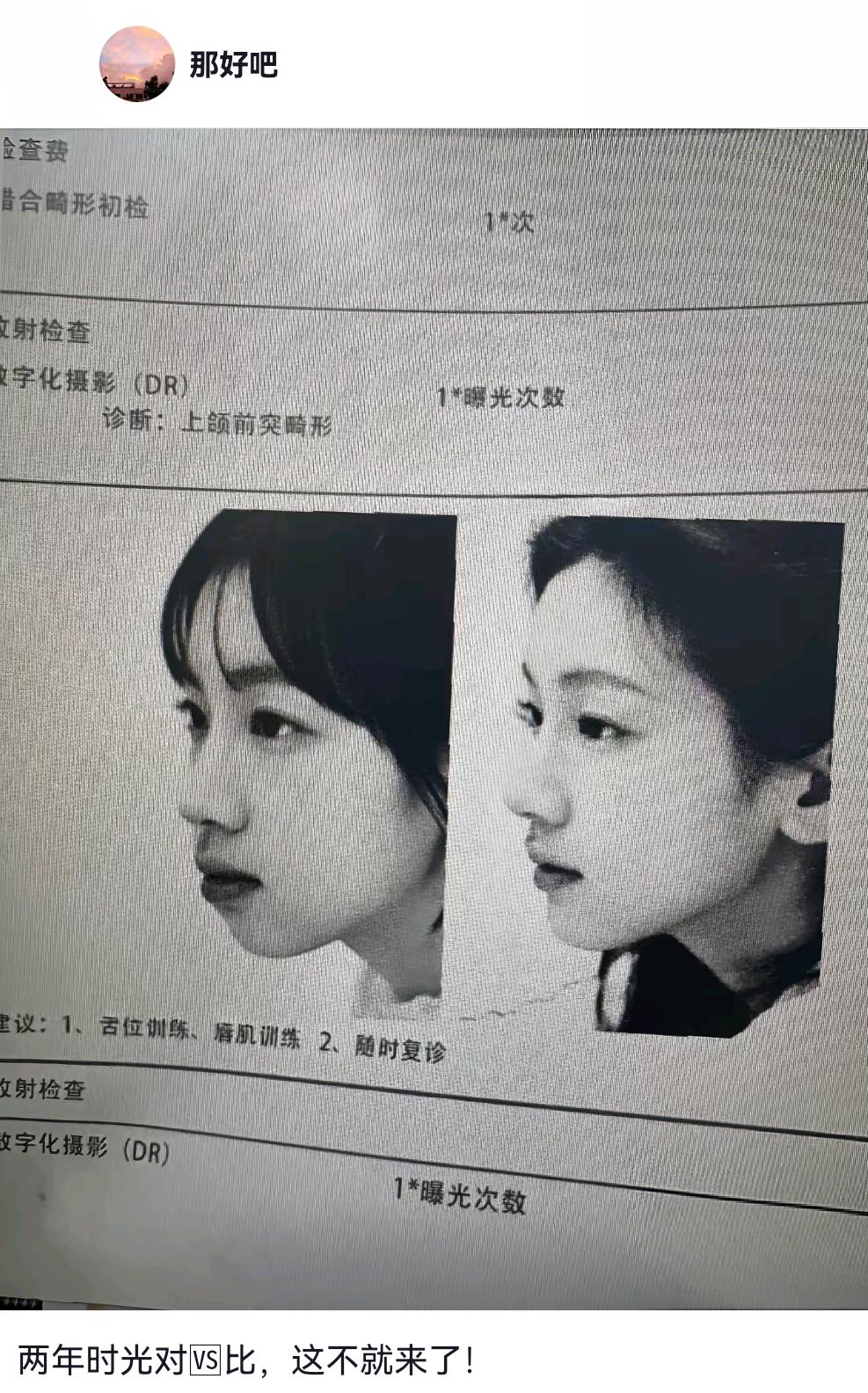 这位美女整牙前后最大的变化是什么？