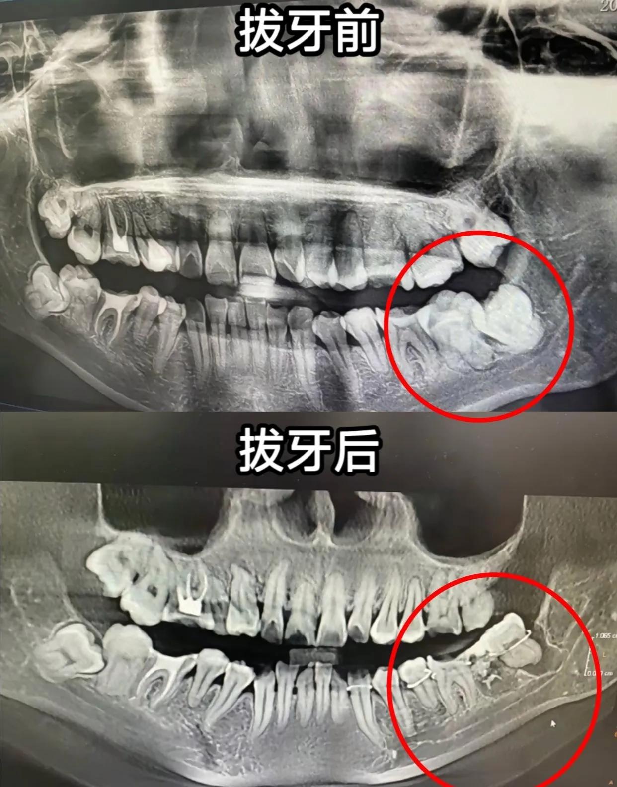 太可怕了，拔牙变拔命，为了一颗牙竟赔上性命？安徽女子吴芳芳因为拔牙去世，年