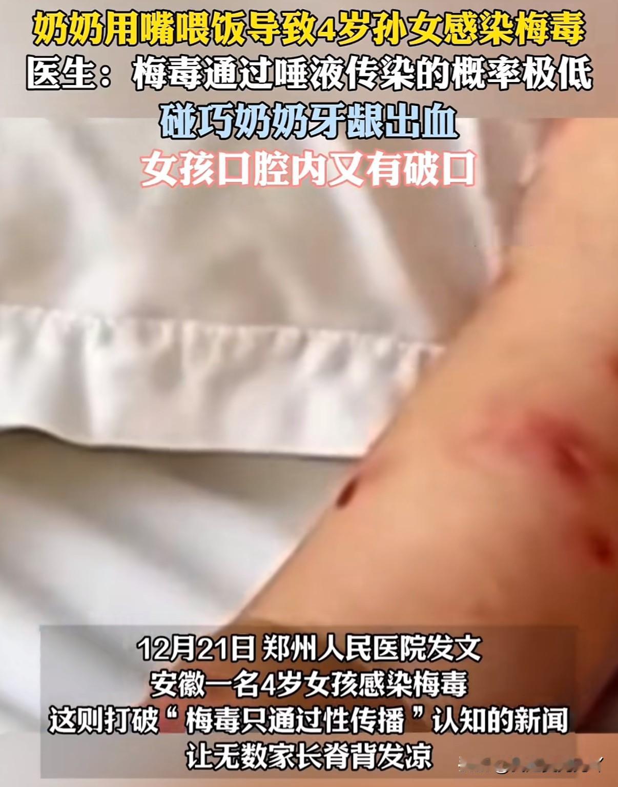 4岁女童患“梅毒”竟是奶奶喂饭喂出来的12月21号郑州人民医院发文称安徽一4岁