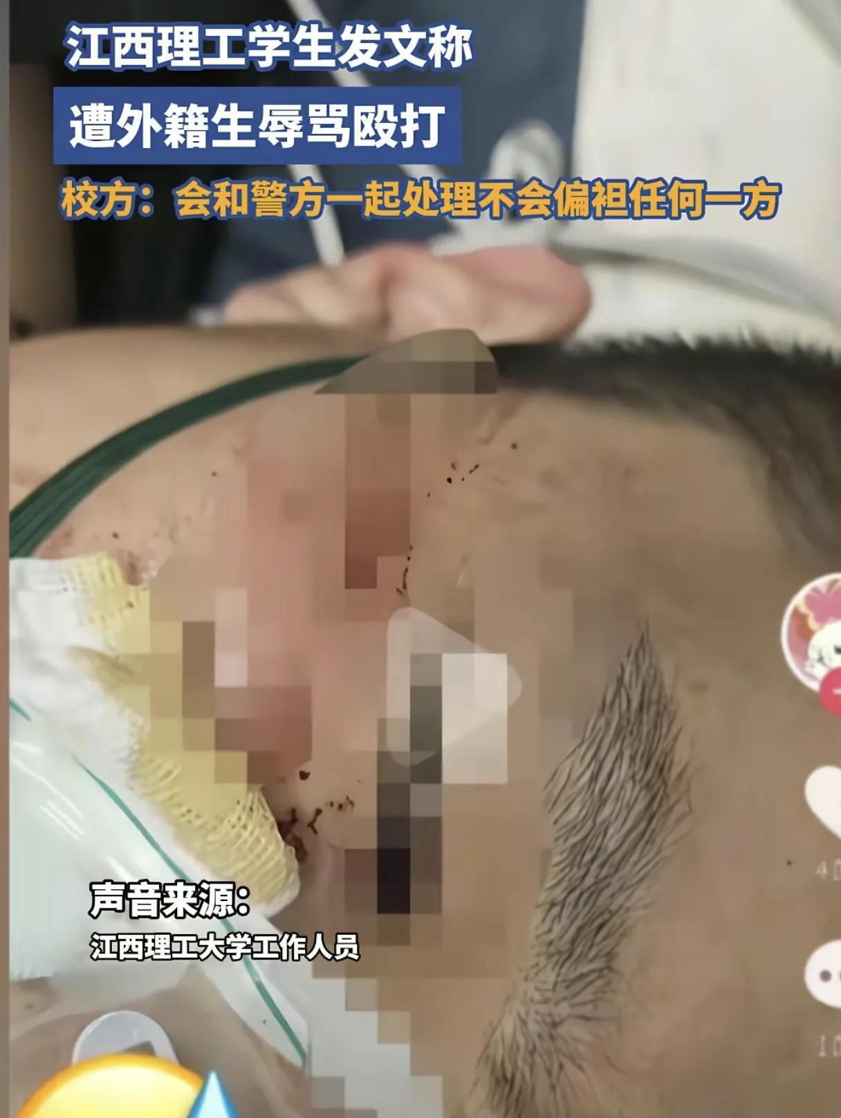 万万没想到，公然殴打中国人的外籍留学生，不仅在中国享受超国民待遇，住双人公寓、疑