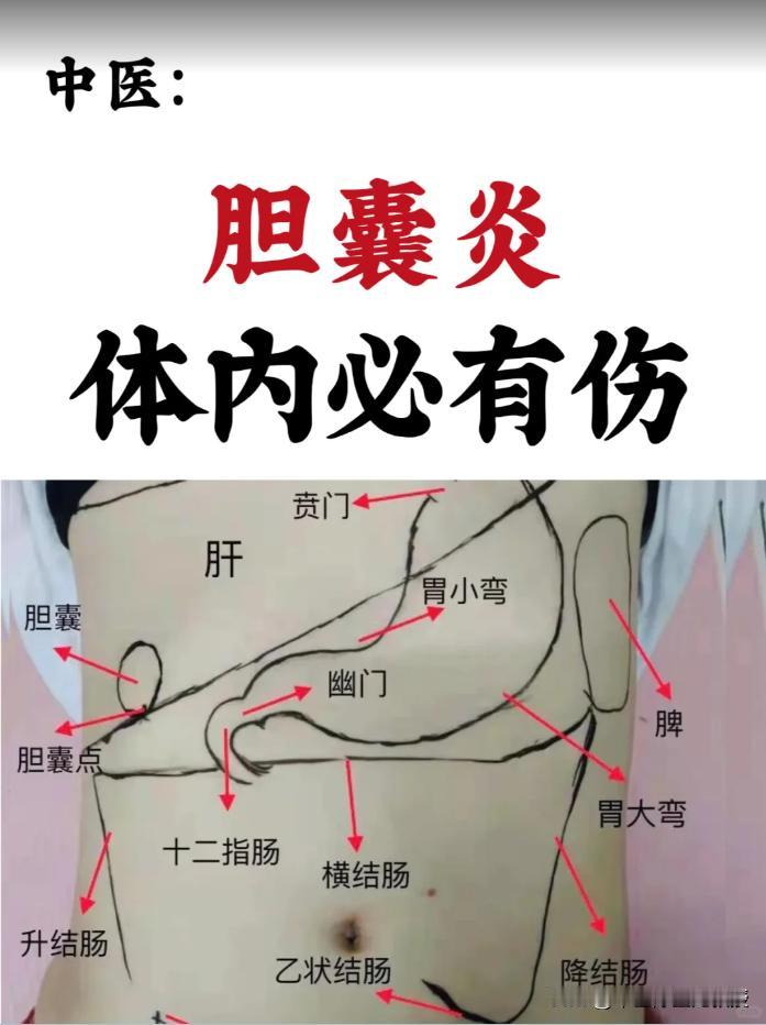 胆囊炎，不仅仅是胆囊的问题，体内必有伤胆囊炎，看似仅是胆囊部位的炎症、感染或
