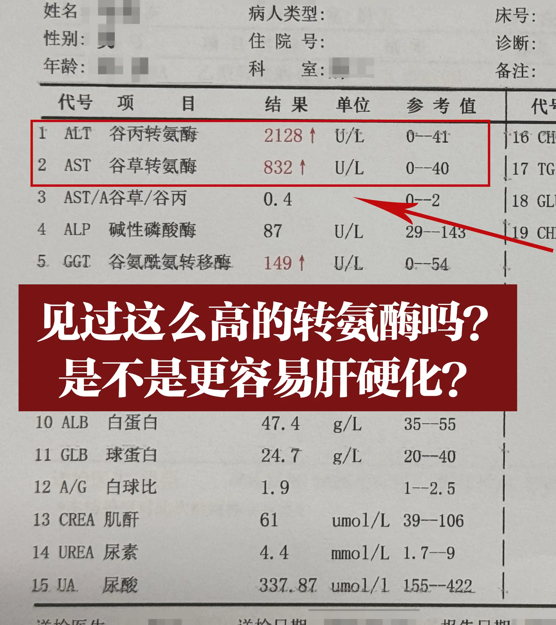 今天接诊了一位山东的乙肝患者，自己做小买卖，从小查出乙肝就没当回事，总...