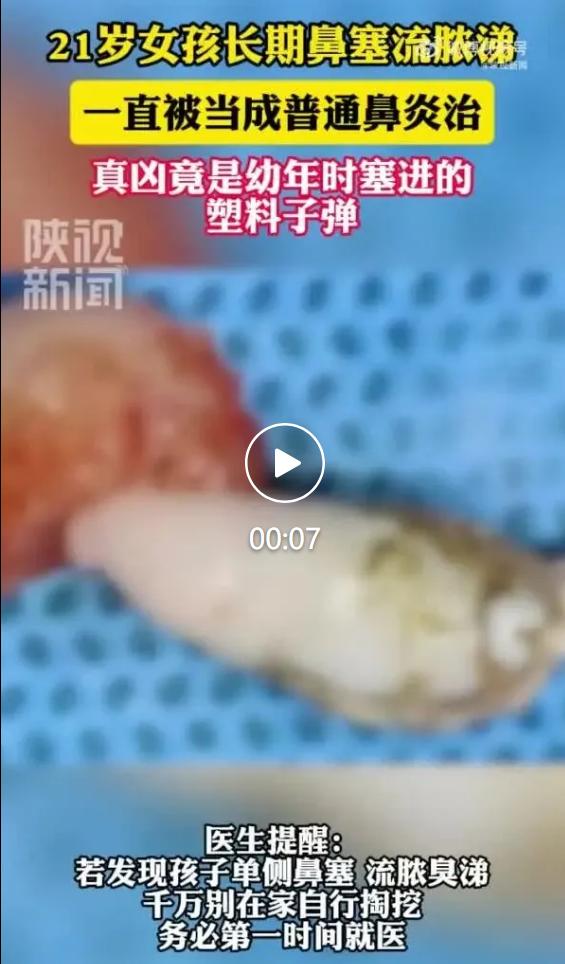 浙江医院耳鼻咽喉科接诊了21岁杭州女孩小凡，多年来她右侧鼻腔一直反复出现黏浊