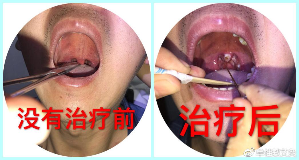 火针治疗咽炎、咽颊炎, 悬雍垂肿大